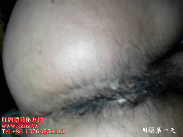 肛周膿腫