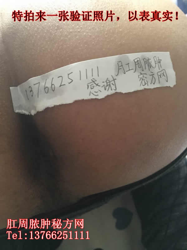 肛周膿腫秘方網