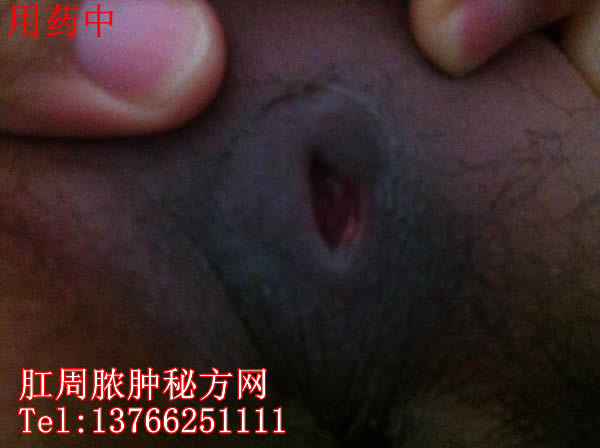 肛周膿腫秘方網