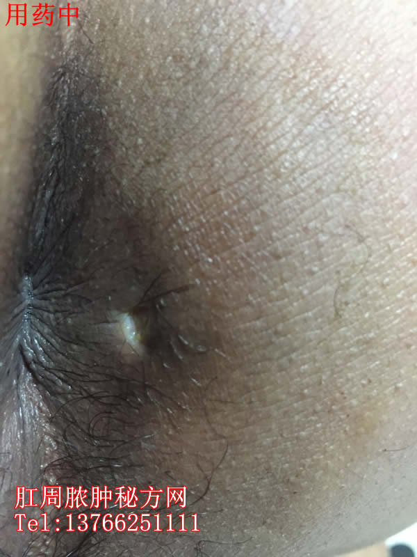 肛周膿腫秘方網
