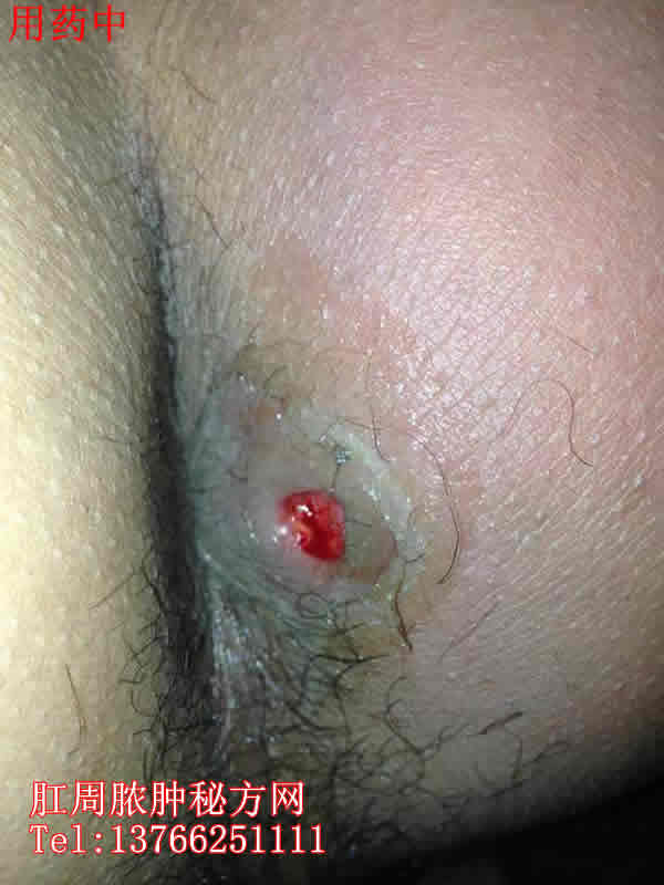 肛周膿腫秘方網