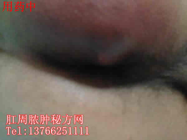 肛周膿腫秘方網