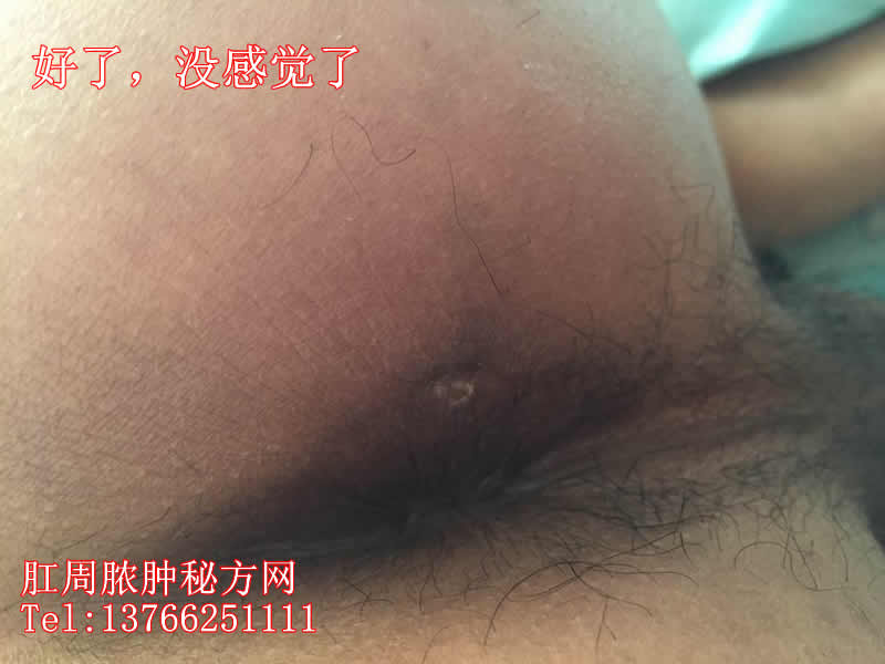 肛周膿腫秘方網